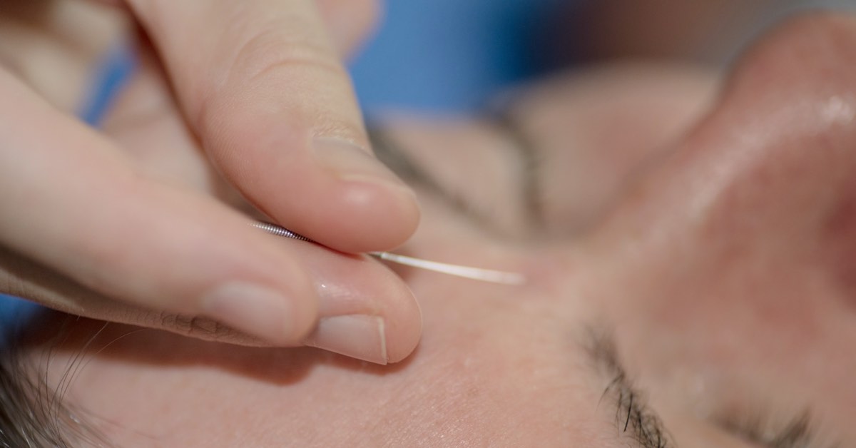 Frau bekommt eine Akupunkturnadel in die Stirn gestochen