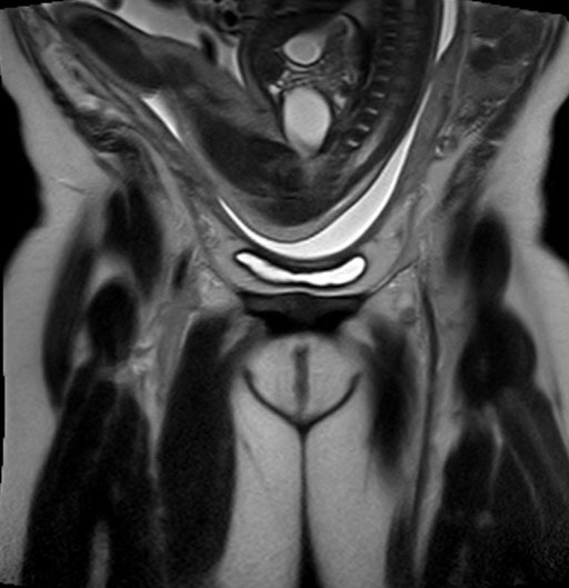 Beckenendlage in der Magnetresonanztomographie.