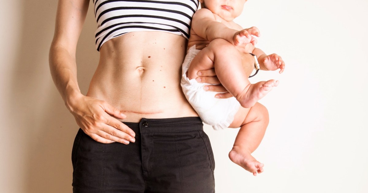 Junge Mutter mit Kaiserschnittnarbe und ihr Neugeborenes
